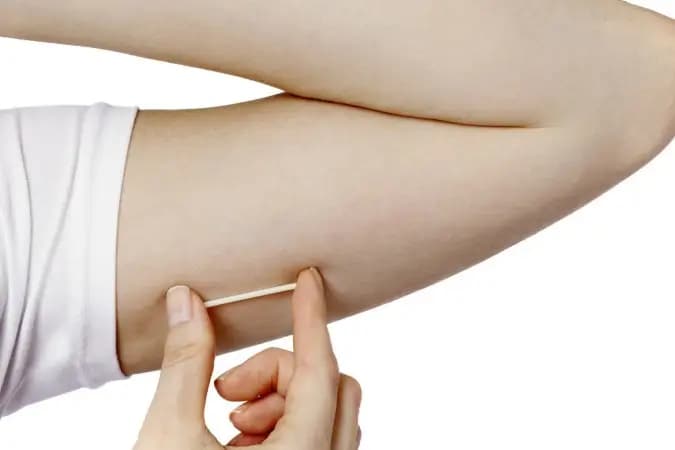 Anvisa amplia uso de implante contraceptivo de três para cinco anos