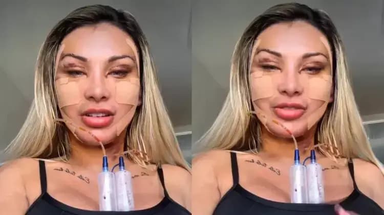 Andressa Urach gasta R$ 100 mil em cirurgia para voltar a ter 20 anos